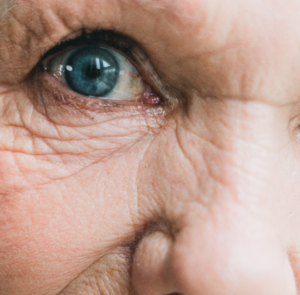 wrinkles under eye